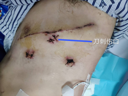 后怕!夫妻吵架,丈夫竟被妻子用刀刺伤心脏