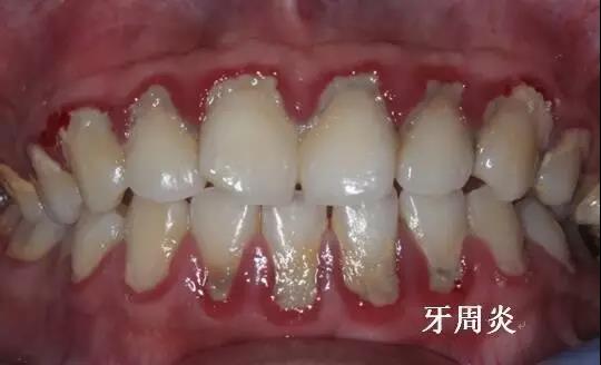 牙龈炎的早期三大症状图片
